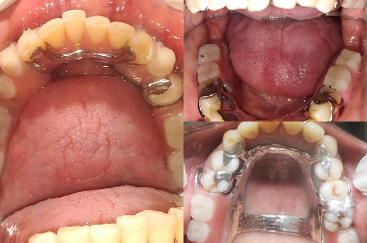 Cast Partial Denture