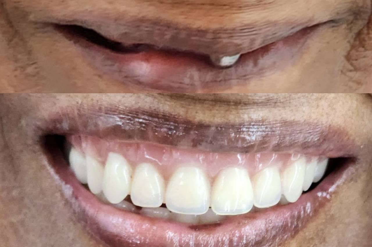 Complete denture