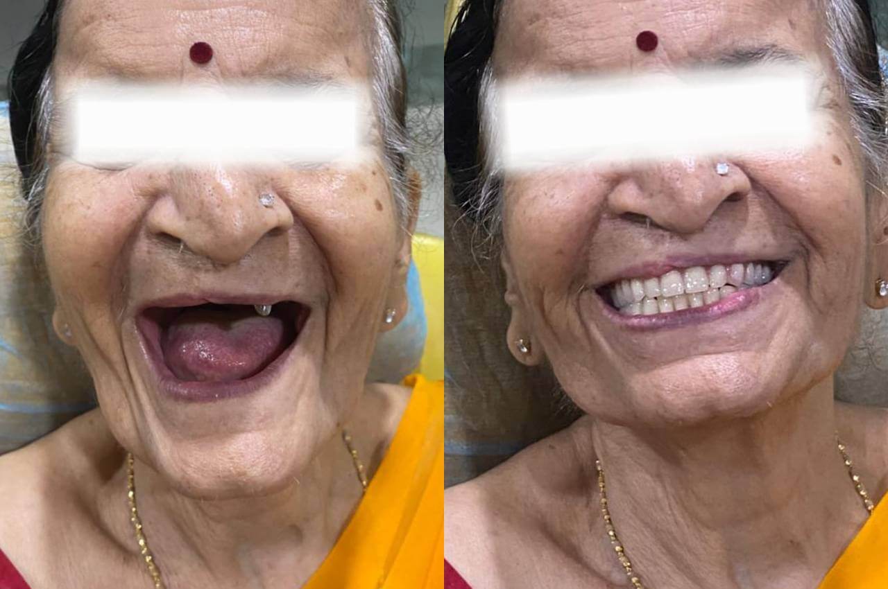 Complete denture