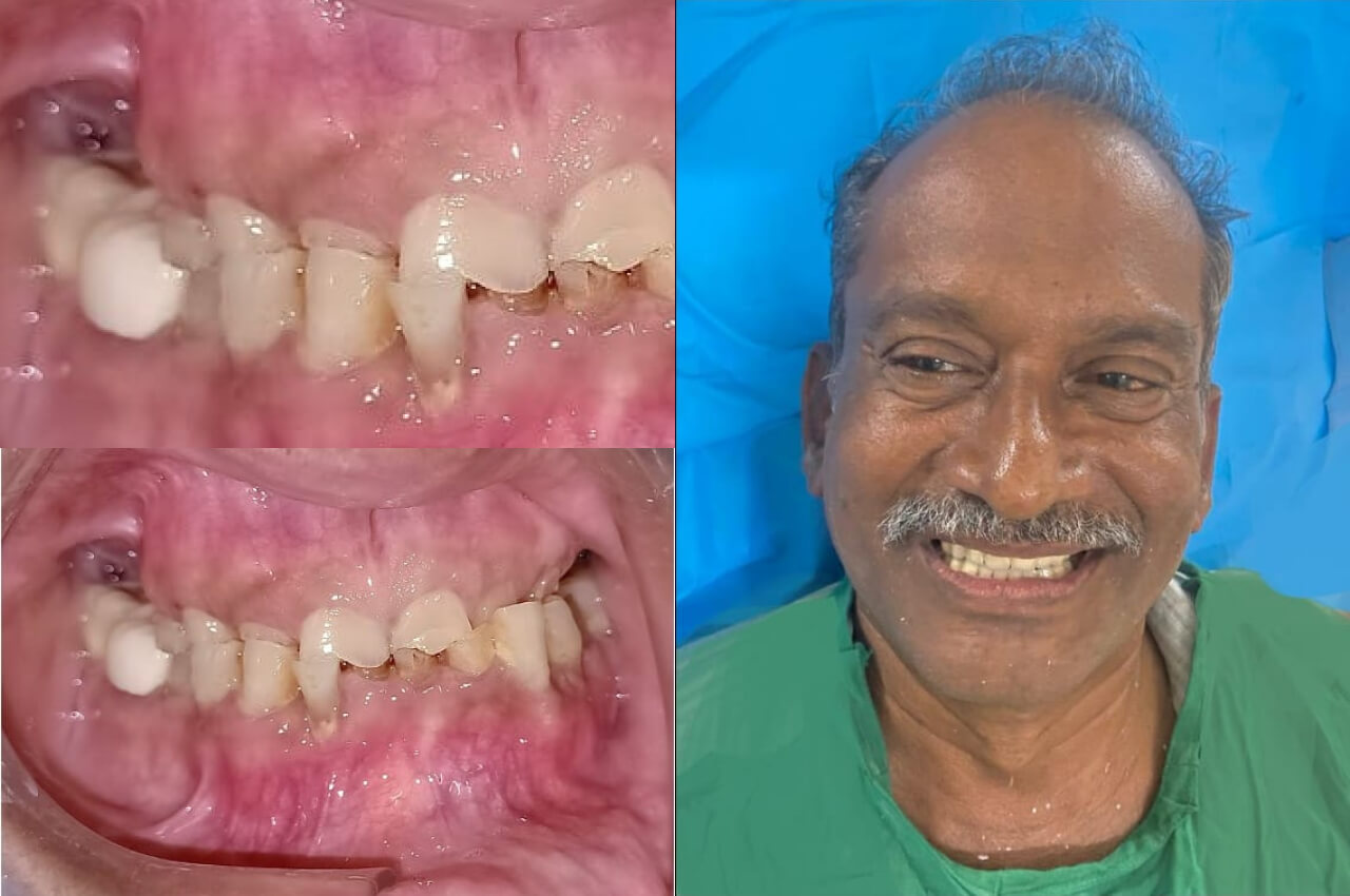 Complete denture