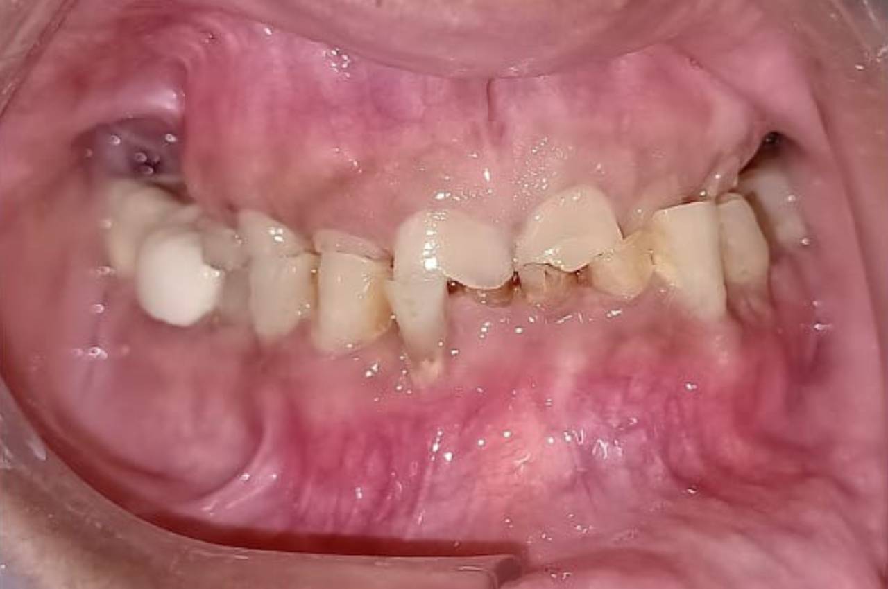 Complete denture