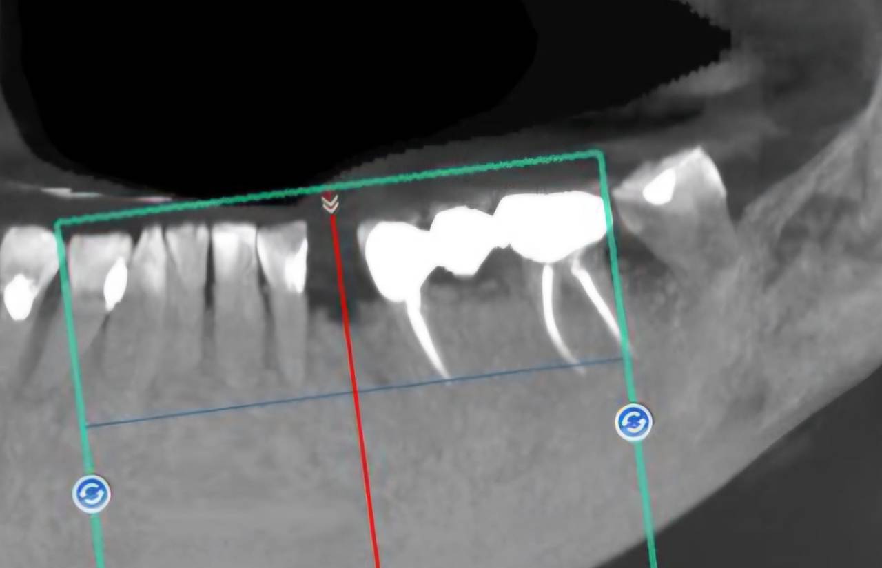 Root Canal